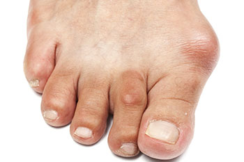 Bunions treatment in the Clark County, NV: Las Vegas (Paradise, Summerlin South, Spring Valley, Enterprise, Winchester, Sunrise Manor, Sloan, Blue Diamond, Henderson) areas