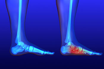 Flat feet and Fallen Arches treatment, Flatfoot Deformity Treatment in the Clark County, NV: Las Vegas (Paradise, Summerlin South, Spring Valley, Enterprise, Winchester, Sunrise Manor, Sloan, Blue Diamond, Henderson) areas