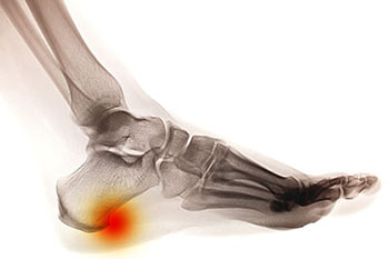 Heel spurs treatment in the Clark County, NV: Las Vegas (Paradise, Summerlin South, Spring Valley, Enterprise, Winchester, Sunrise Manor, Sloan, Blue Diamond, Henderson) areas