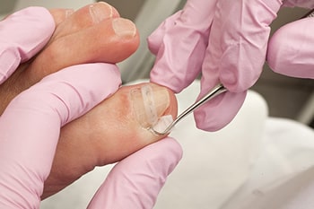 Ingrown toenails treatment in the Clark County, NV: Las Vegas (Paradise, Summerlin South, Spring Valley, Enterprise, Winchester, Sunrise Manor, Sloan, Blue Diamond, Henderson) areas