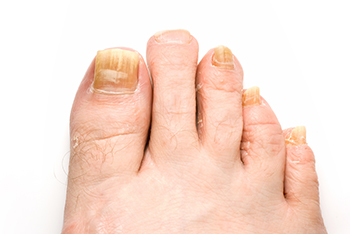 Fungal toenails, toenail fungus diagnosis and treatment in the Clark County, NV: Las Vegas (Paradise, Summerlin South, Spring Valley, Enterprise, Winchester, Sunrise Manor, Sloan, Blue Diamond, Henderson) areas