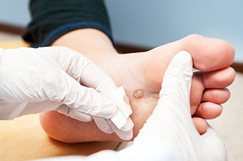 Plantar warts specialist in the Clark County, NV: Las Vegas (Paradise, Summerlin South, Spring Valley, Enterprise, Winchester, Sunrise Manor, Sloan, Blue Diamond, Henderson) areas