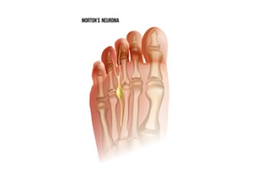 Symptoms of Morton&#039;s Neuroma