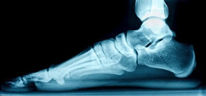 How to Determine If You Have Flat Feet