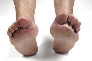 How Can Rheumatoid Arthritis Impact Feet?