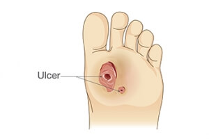 How Podiatrists Can Help With Diabetic Foot Ulcers