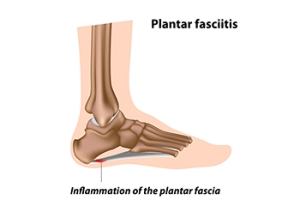 What Can Cause Plantar Fasciitis?
