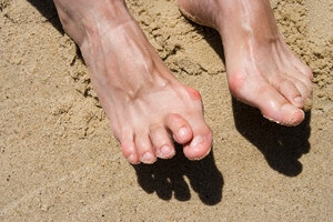 Reasons Hammertoe Can Develop