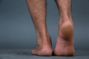 Lifestyle Factors and Medical Reasons for Cracked Heels