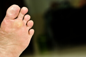 Teens and Plantar Warts